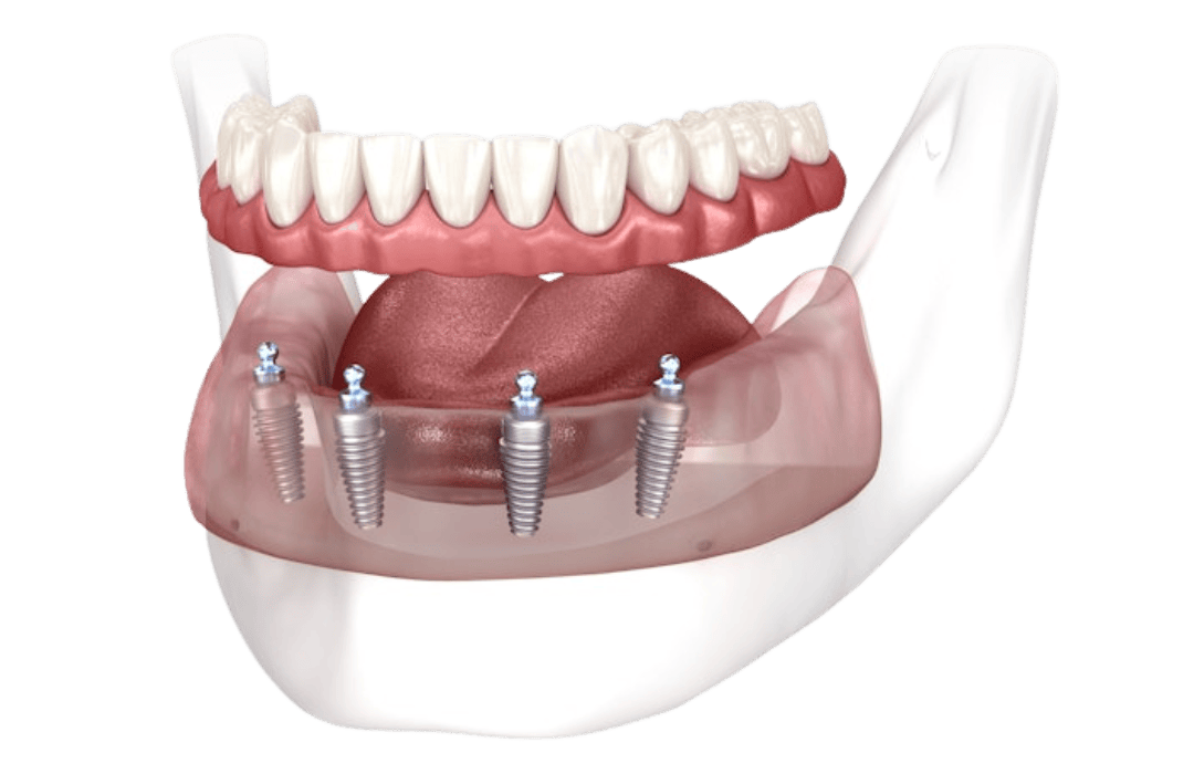 Top Dental Implant Provider In Stamford